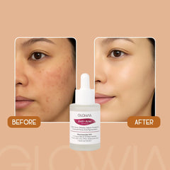 Anti-Acne Serum
