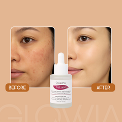 Anti-Acne Serum